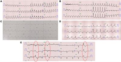 Case report: Stereotactic body radiation therapy with 12 Gy for silencing refractory ventricular tachycardia